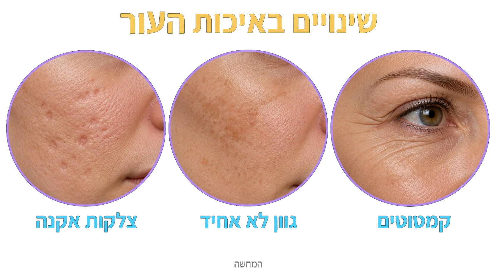 שינויים באיכות העור: קמטוטים, גוון לא אחיד וצלקות אקנה.