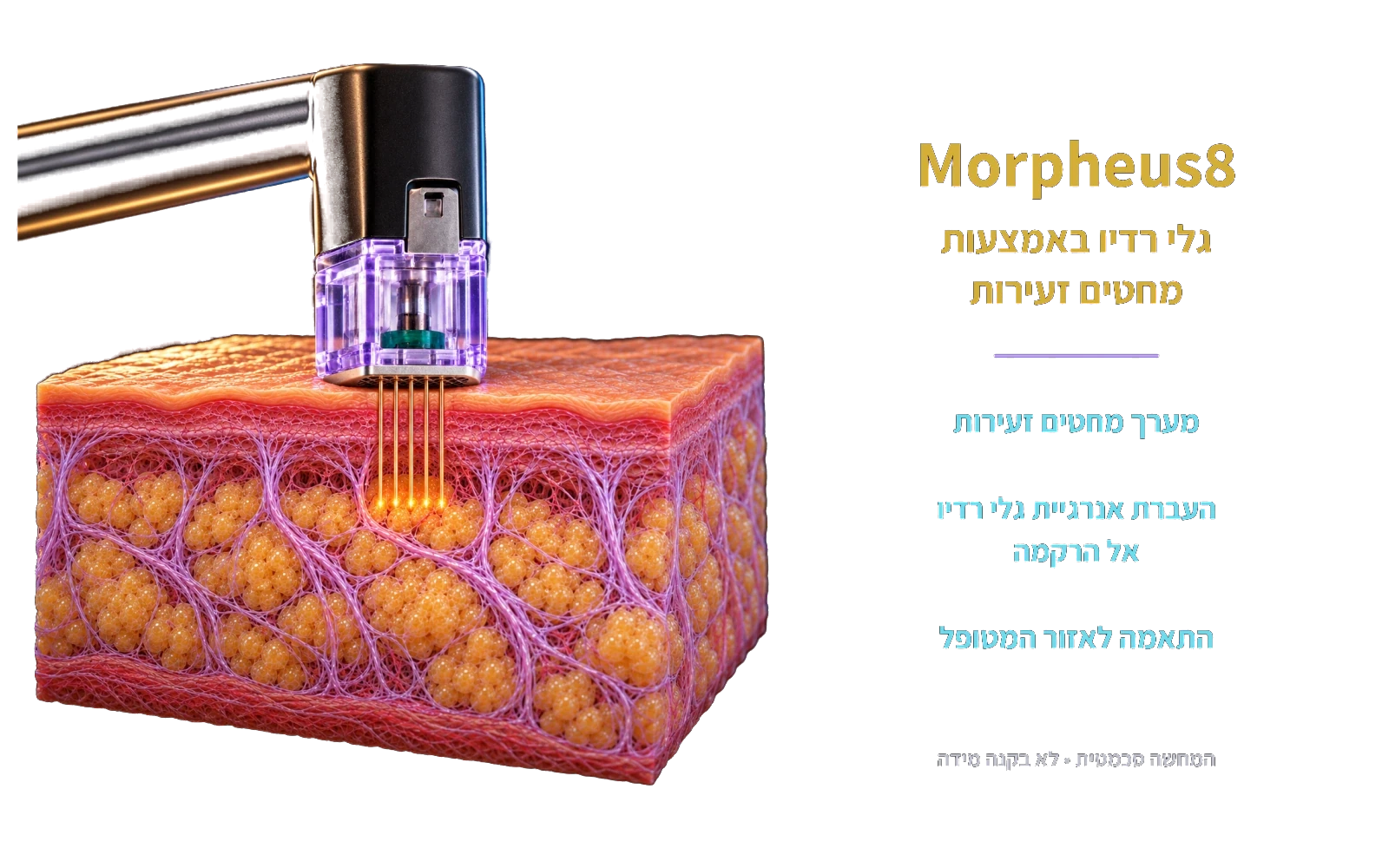 Morpheus8: העברת אנרגיית גלי רדיו באמצעות מערך מחטים זעירות. המחשה סכמטית שאינה בקנה מידה.